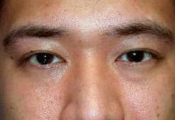 eyelidcreasecorrectionafter.jpg