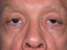 ptosis1.jpg