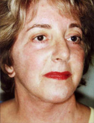 webassets/faceandnecklift3quartafter.jpg