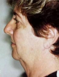 webassets/faceandneckliftprofilebefore.jpg